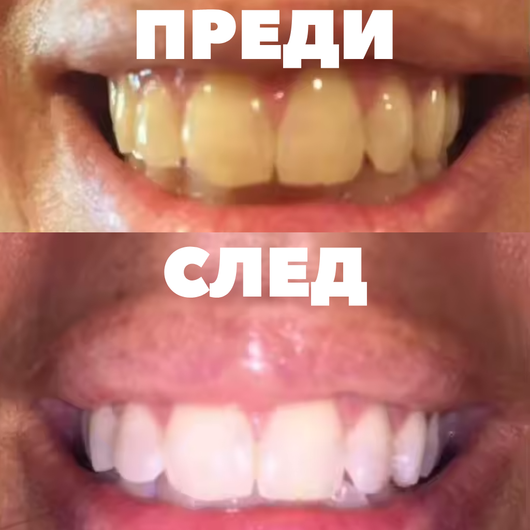 SparkSmile - V34 (серум за избелване)
